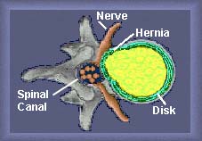 Top view herniated disk